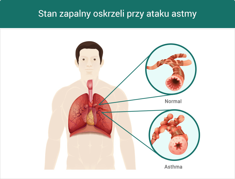 Astma Przyczyny Objawy I Leczenie Doc