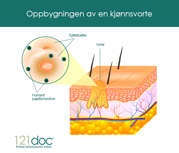 Illustrasjon av hvordan HPV (humant papillovirus) forårsaker kjønnsvorter