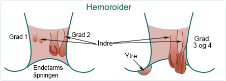 hemoroider