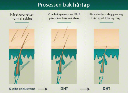 Prosessen bak hårtap hvor produksjonen av DHT påvirker hårveksten og gjør at du mister håret