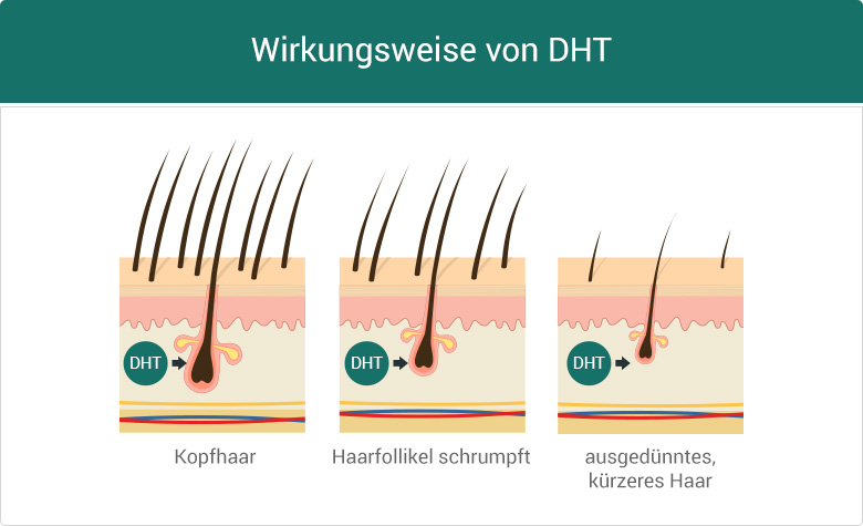 Wirkung DHT Haarfollikel Propecia Finasterid Haarausfall Alopezie