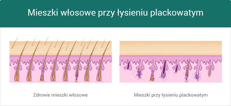 Porównanie miekszów włosowych - zdrowie i łysienie plackowate