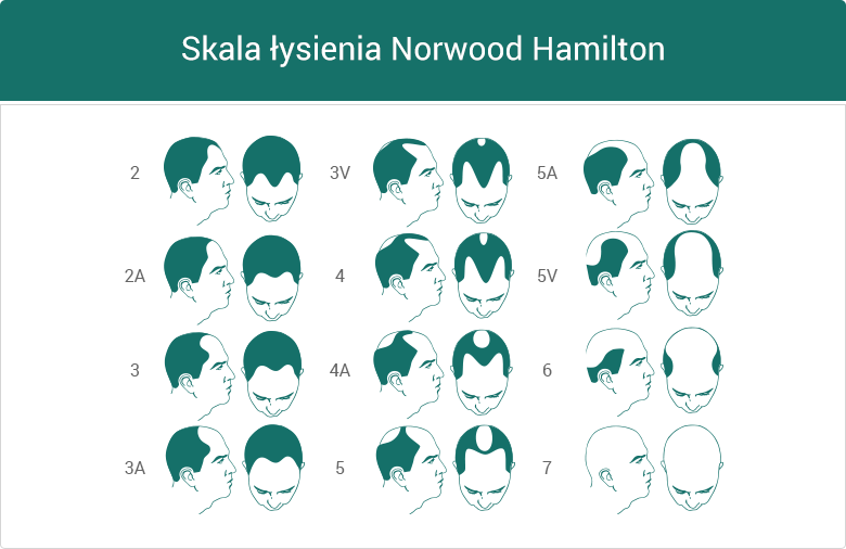 Skala łysienia Norwood Hamilton - grafika