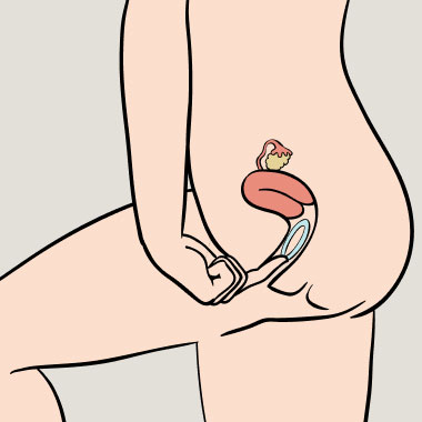 Ilustração de um anel contracetivo colocado dentro da vagina de uma mulher.