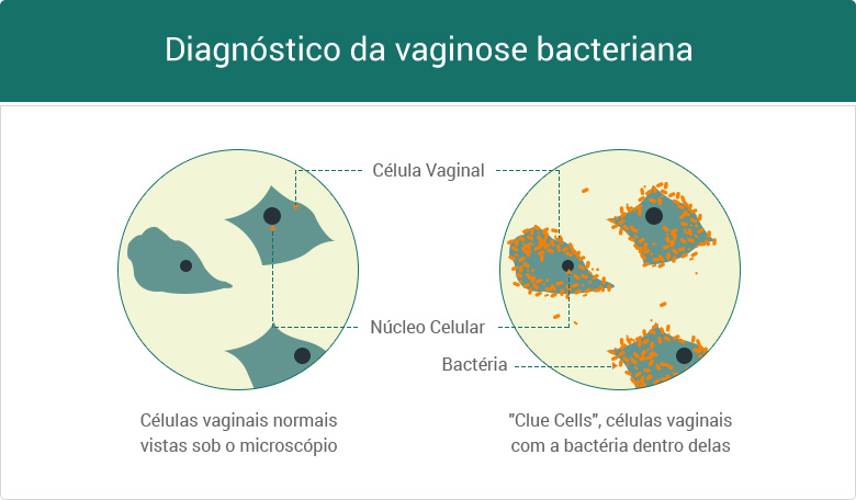 Diagnostico da vaginose bacteriana
