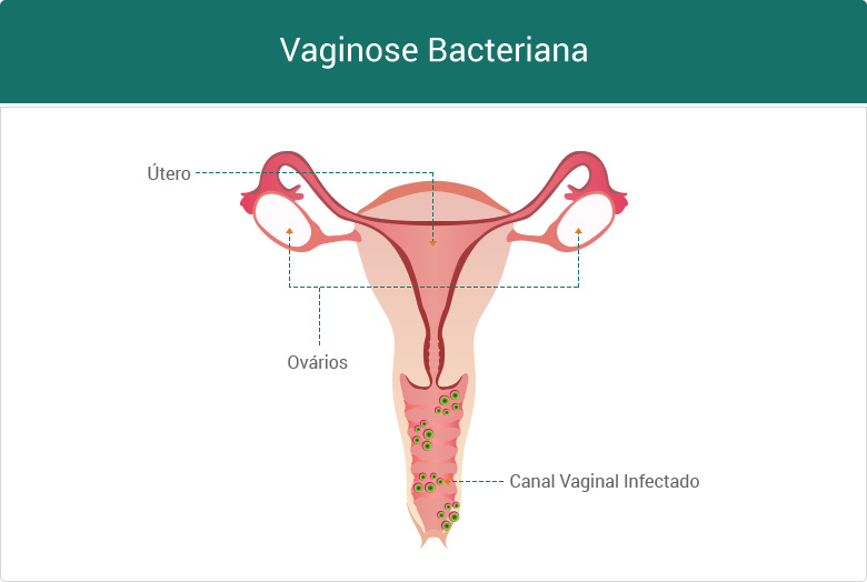 Vaginose Bacteriana