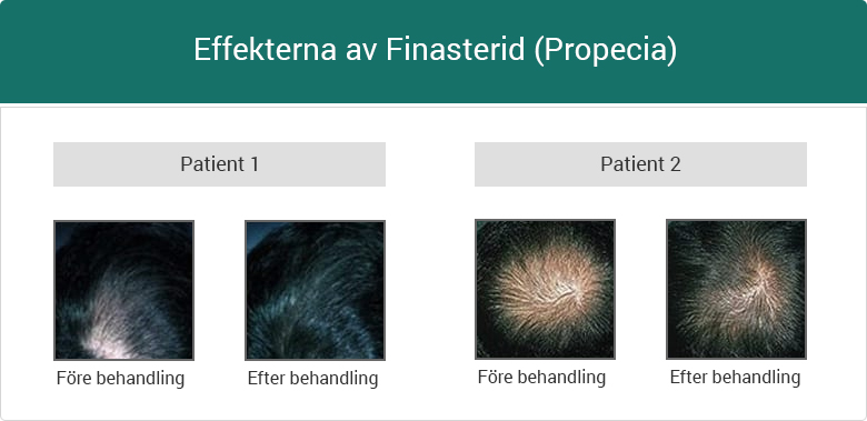 Effekterna av Finasterid (Propecia)